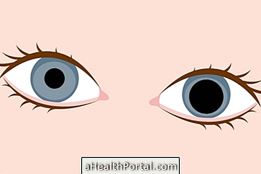 What is Adie's Pupil and How to Treat