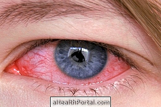 Bacteriële conjunctivitis: symptomen en behandeling