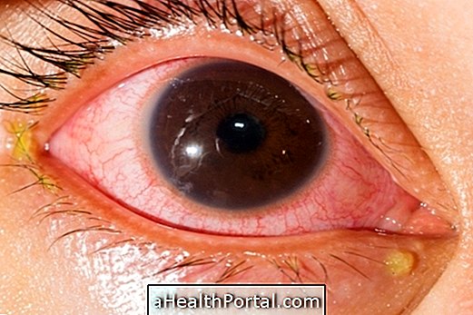 Uveitis का इलाज कैसे करें