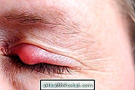 What is terçol in the eye and how to cure