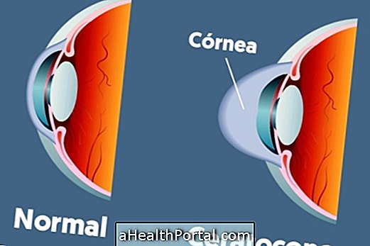 Cos'è il cheratocono e i sintomi principali