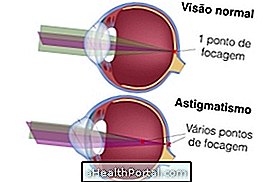 Symtom på astigmatism och hur man behandlar