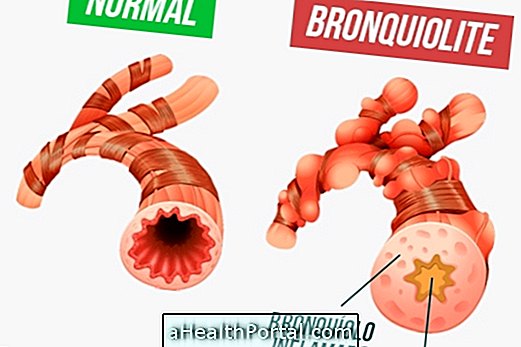 A bronchiolitis azonosítása és megelőzése