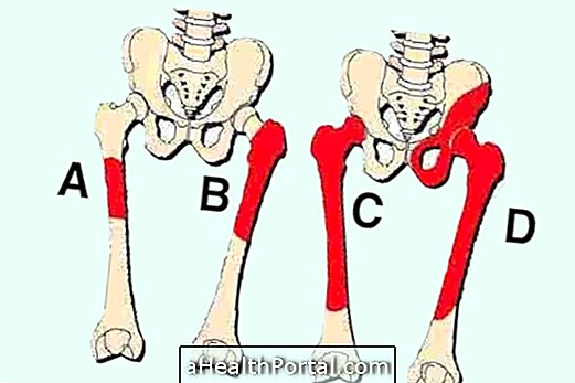 Was ist der kurze angeborene Femur?