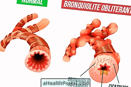 How to identify and treat bronchiolitis obliterans