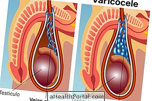 Apakah varicocele dan bagaimana pembedahan dilakukan