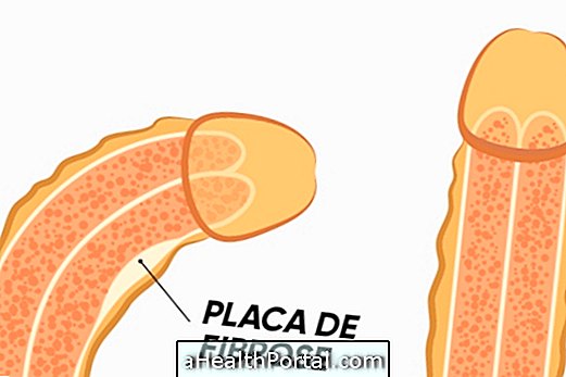 Hvordan identifisere og behandle Peyronies sykdom