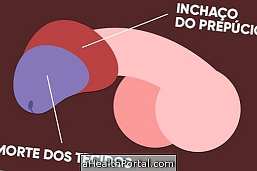 Paraphimosis'in tedavisi nedir ve nasıl yapılır