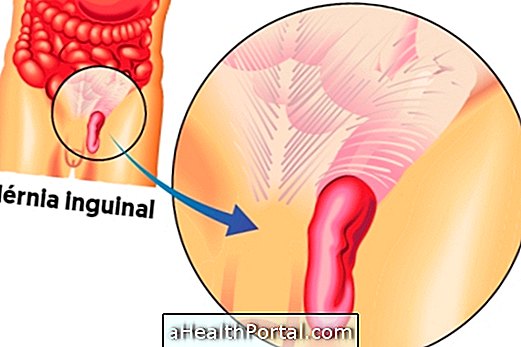 Apa itu Hernia Inguinal dan Bagaimana Mengobatinya