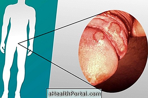 Come identificare e curare la candidosi negli uomini