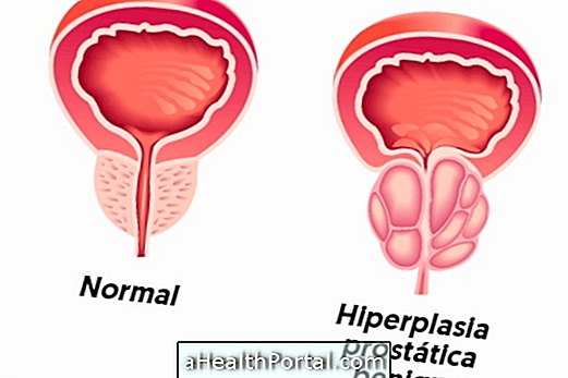 Co je benigní hyperplazie prostaty a jak ji léčit