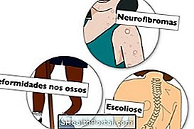 Gejala neurofibromatosis