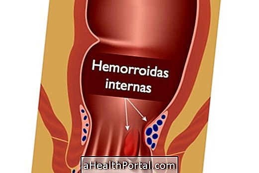 Miten tunnistaa, onko se sisäinen hemorrhoid