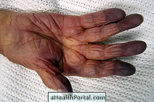 Cyanosis: what it is, the main causes and how the treatment is done