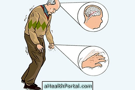 Merkittävät merkit ja Parkinsonin taudin oireet