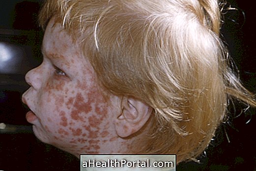 Signs and Symptoms of Rubella