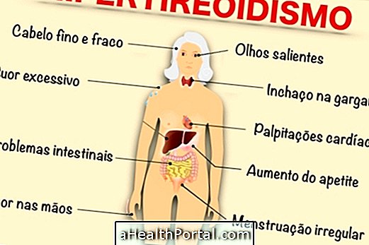 Gejala Hyperthyroidism