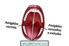 อาการของ Mononucleosis