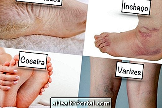 Symptoms of poor circulation in the legs