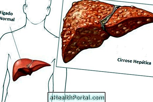 أعراض تليف الكبد