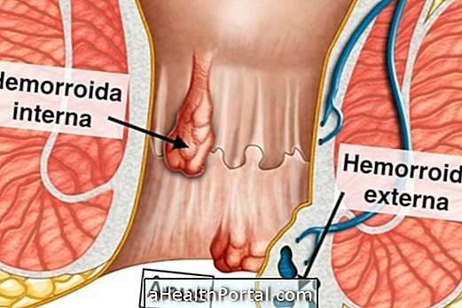 Nyeri di anus dan perdarahan mungkin menunjukkan wasir