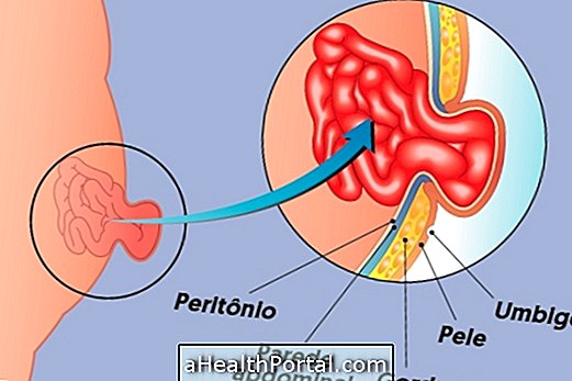 Các triệu chứng của thoát vị rốn