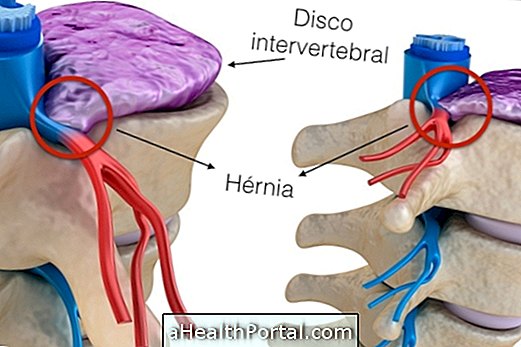 איך לדעת הוא דיסק herniated ומה הם הסימפטומים העיקריים