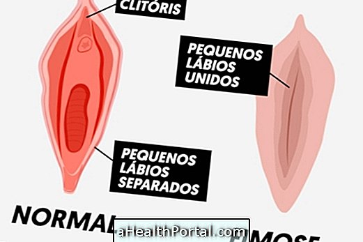 Endoskopi wanita: apa itu dan bagaimana untuk merawatnya