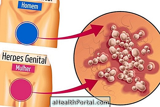 Her er hvordan du identifiserer symptomene på genital herpes