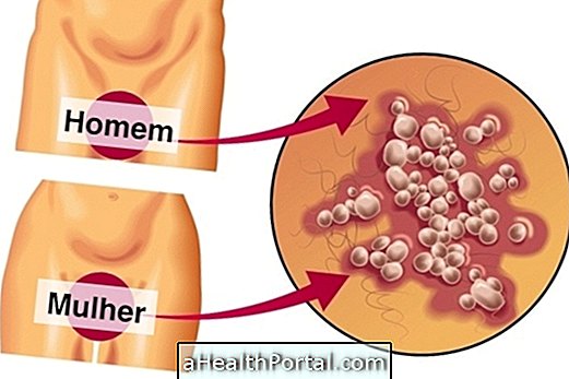 Làm thế nào để xác định Herpes sinh dục