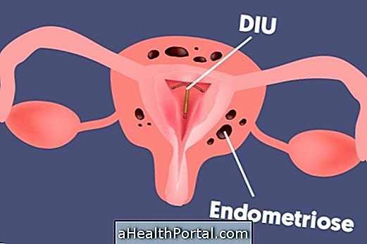 Mirena ต่อสู้กับ Endometriosis