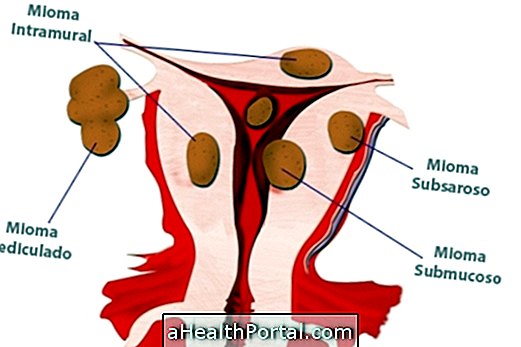 Vrste fibroidov maternice