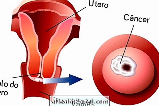 7 cara untuk merawat kanser serviks