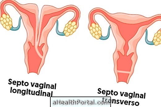 Apa itu septum vagina dan bagaimana mengobatinya