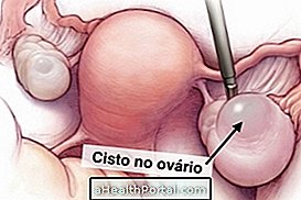 Cara Mengidentifikasi dan Mengobati Kista Ovarium