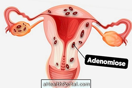 Adenomyosis là gì, nguyên nhân và triệu chứng chính