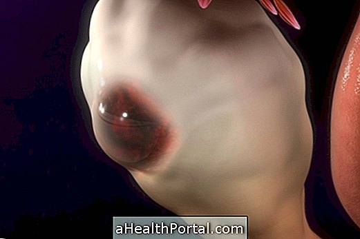 Treatment for ovarian cyst