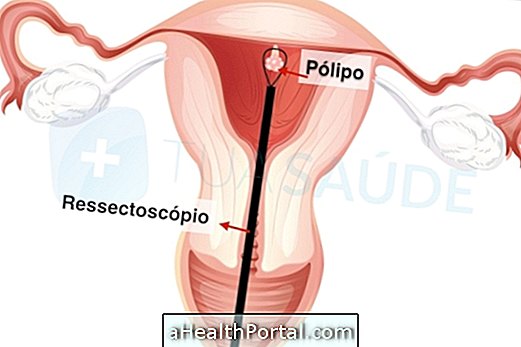 Uterin polip kaldırmak için ameliyat ne zaman